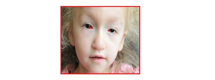 Causes of Strabismus and How it can be treated